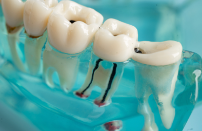 A close-up of a dental model showing realistic human teeth with visible roots in a clear blue base.