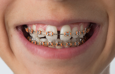 A close-up of a smiling person showing teeth with orange and silver braces, highlighting dental treatment.