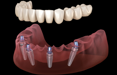 3D rendering of upper and lower teeth, with dental implants shown in the lower jaw, indicating restorative dentistry.