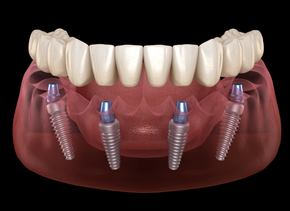 A digital illustration of a mouth showing dental implants placed in the gums beneath a set of upper teeth.