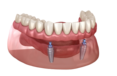 A detailed dental model showing an upper set of teeth with two dental implants at the base.