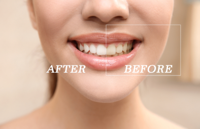 A close-up of a smiling woman showing her teeth, labeled "AFTER" on the left and "BEFORE" on the right.